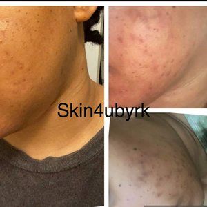 Anti acne whitening soap